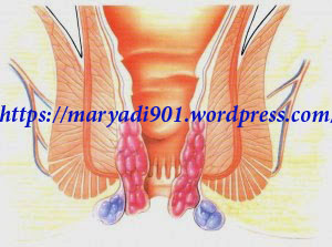 Illustration for article titled Cara Mengatasi Ambeien Tanpa Operasi